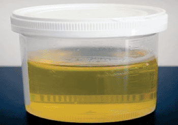 Image: Urine sample for Mi-Prostate Score Test (University of Michigan Health System).